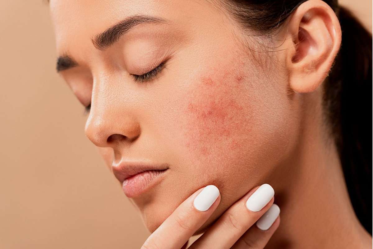 Woman with hormonal acne on her cheek and touching her skin. 