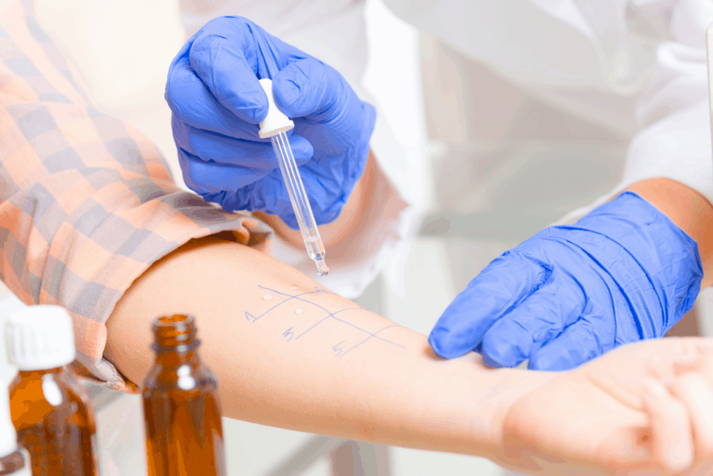 Doctor doing allergy skin prick test for cows milk protein allergy on patient’s arm.